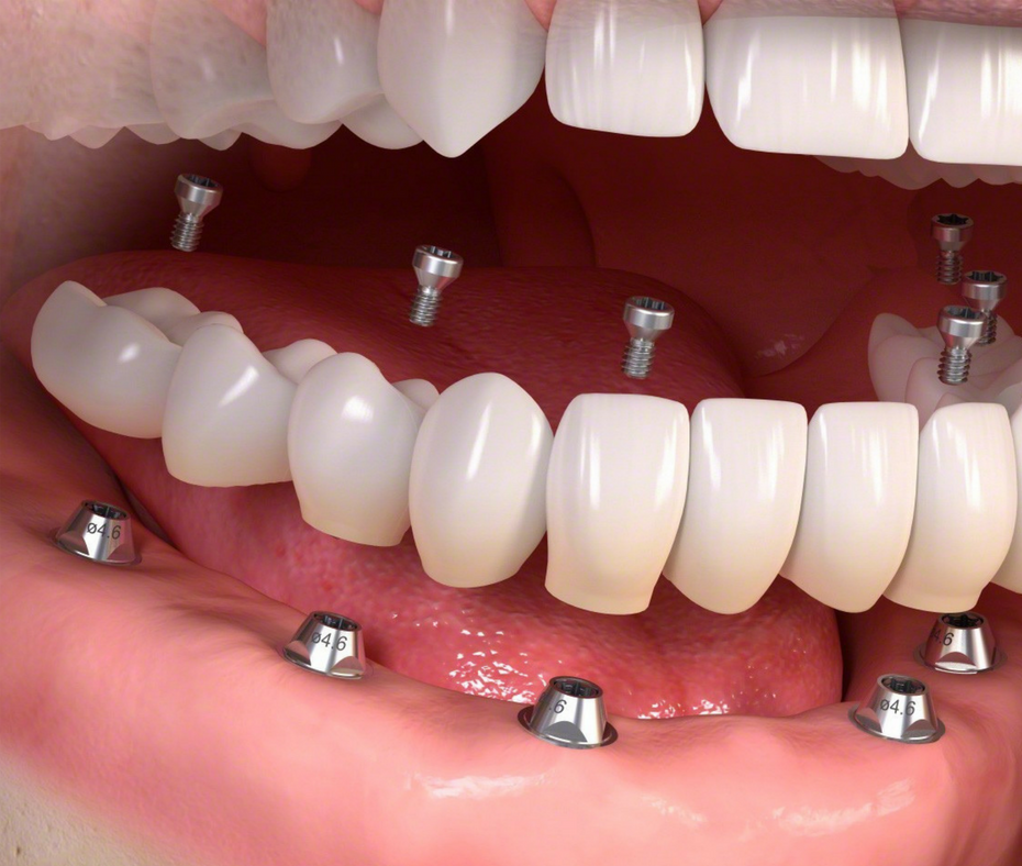 בעזרת התקנה של 6 שתלים בלבד משקמים את כל הלסת עם שיניים חדשות קבועות